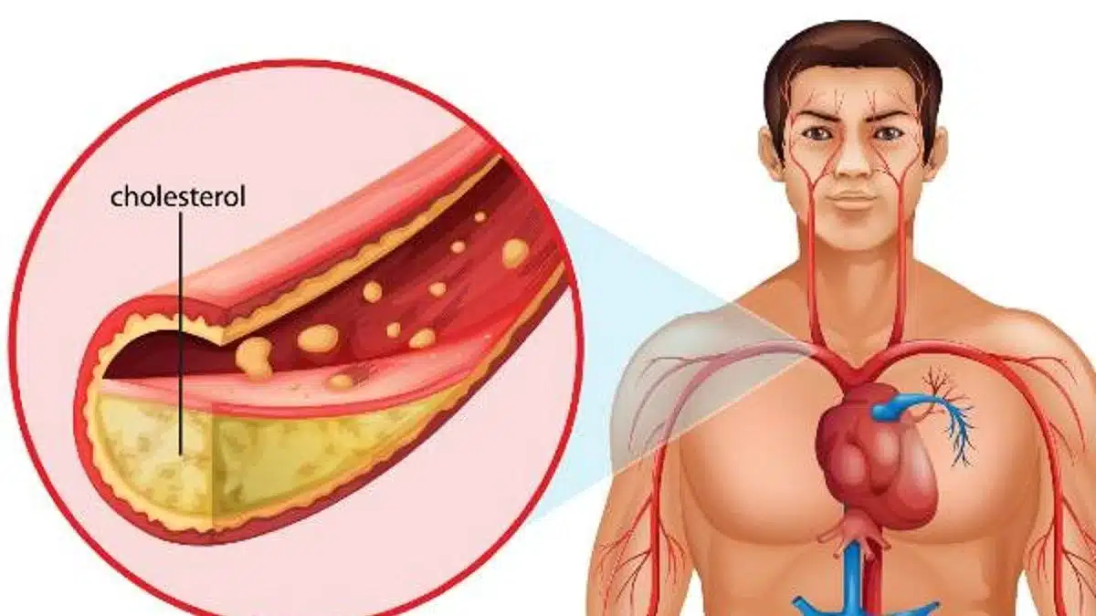 కొలెస్ట్రాల్‌